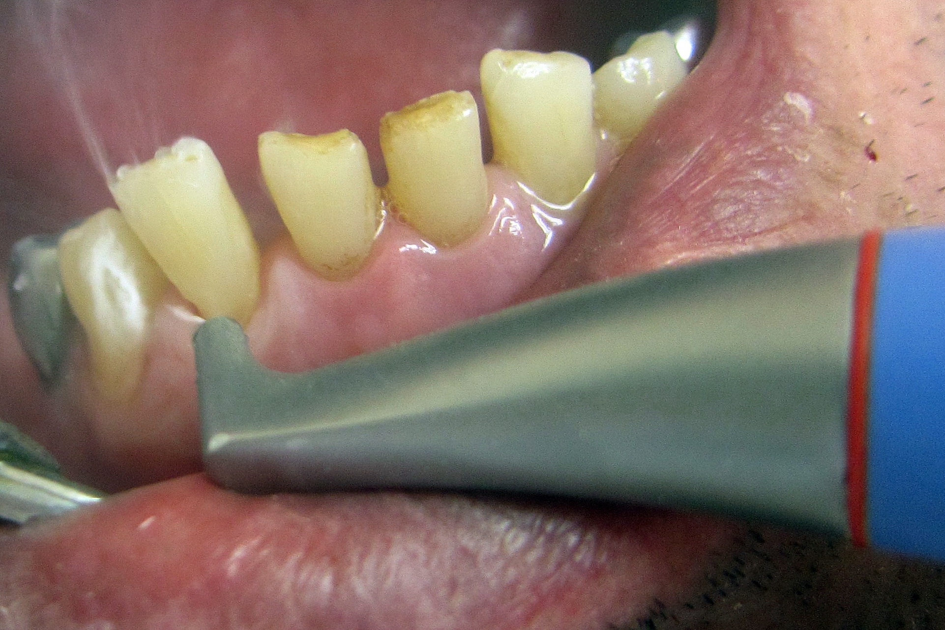 воздушно-абразивный способ устранения кариеса