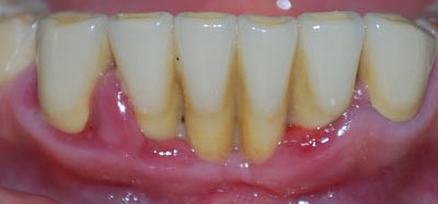 Стадии хронического пародонтита