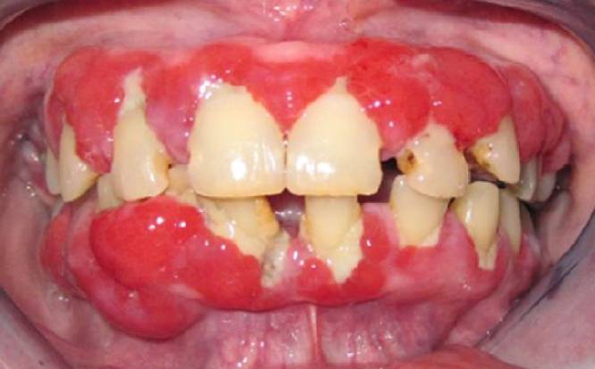 Зубная боль при периодонтите - фото 2