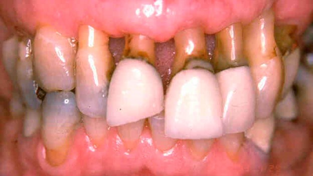 Тяжелая степень пародонтита