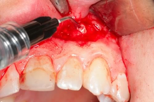 Гранулированный периодонтит - фото 2