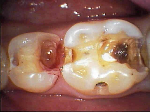 Лечение пульпита без удаления нерва: стадии и особенности - фото 2
