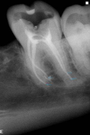 Воспаление пульпита: симптомы, причины, диагностика и лечение - фото 2