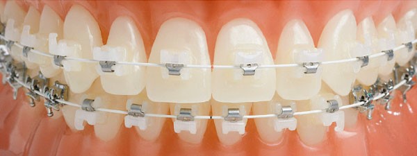 Эстетическая ортодонтия – прозрачные брекеты - фото 2