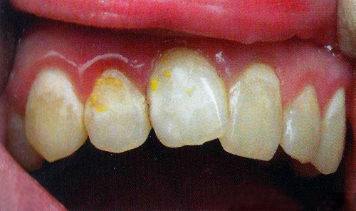 Кариес в стадии пятна