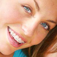 Керамические брекеты: плюсы и минусы - фото 2