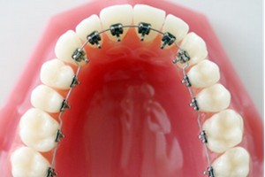 Металлические брекеты – классический вариант ортодонтического лечения - фото 2