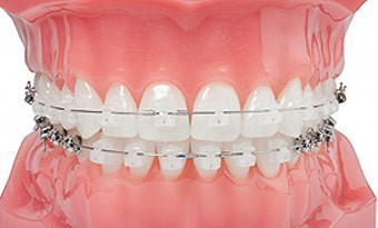 Брекеты Damon Clear: преимущества и недостатки - фото 2