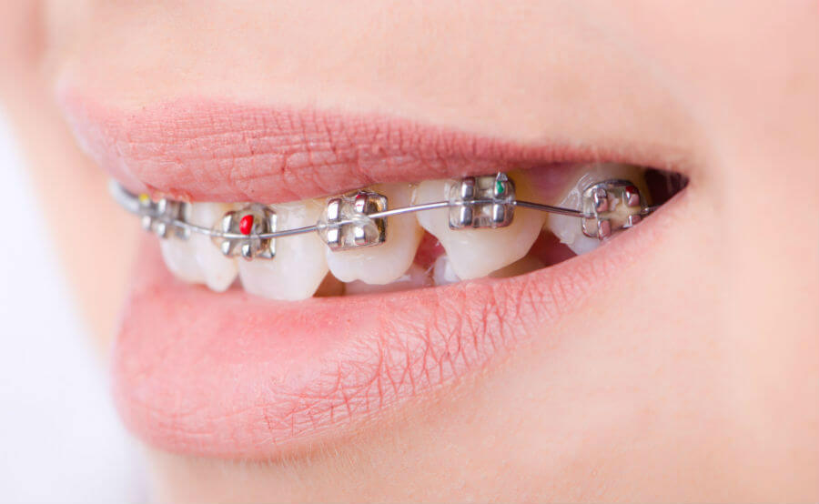 Лечение неправильного прикуса брекет-системами - фото 2