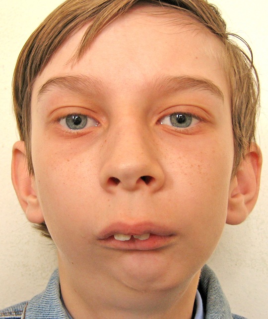 Лечение неправильного прикуса без использования брекетных систем - фото 2