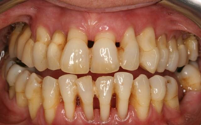 Симптомы пародонтита тяжелой степени