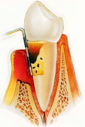 Периодонтит осложнения - фото 2