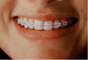 Невидимые брекеты: виды и их особенности - фото 2