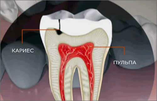 Пульпит зуба: симптомы - фото 2