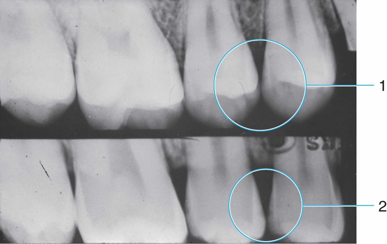 Рентген-снимок зубов с поверхностным кариесом
