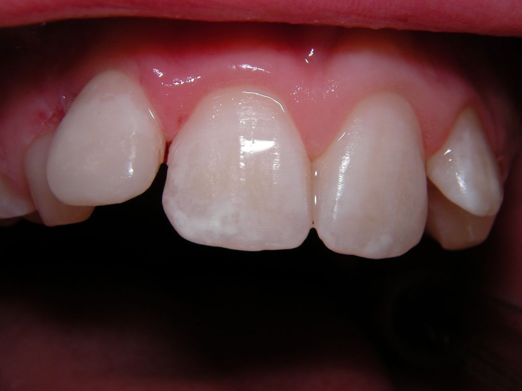 Белый кариес