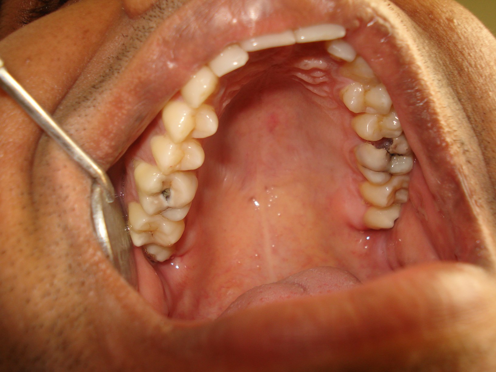 Осмотр зубов с кариесом