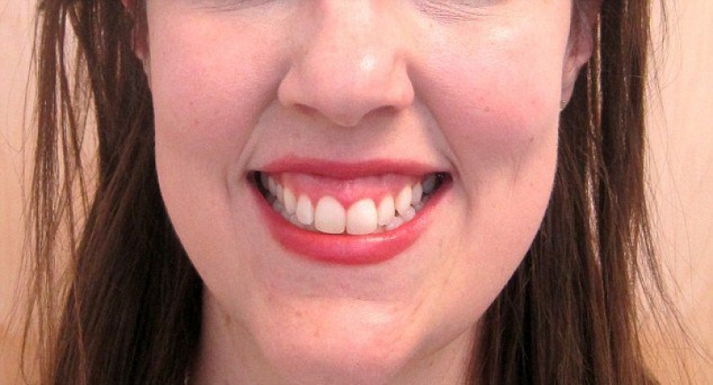 Отличительные особенности глубокого прикуса - фото 3