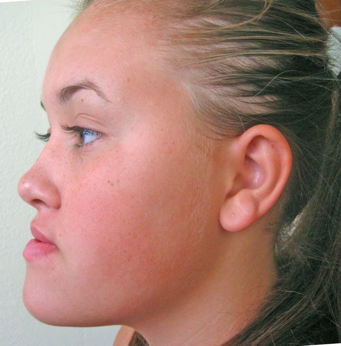 Мезиальный прикус: как обнаружить и вылечить? - фото 3