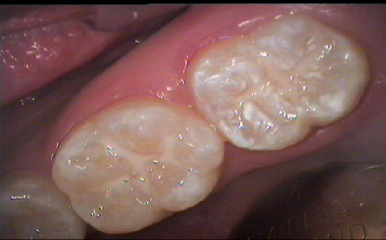 Причины кариеса - фото 1