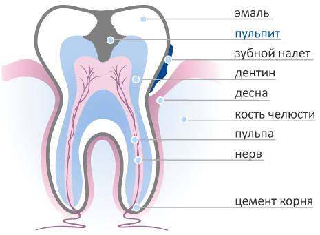 Острый очаговый пульпит, его особенности и лечение - фото 1