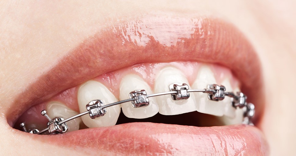 Лечение неправильного прикуса брекет-системами - фото 4