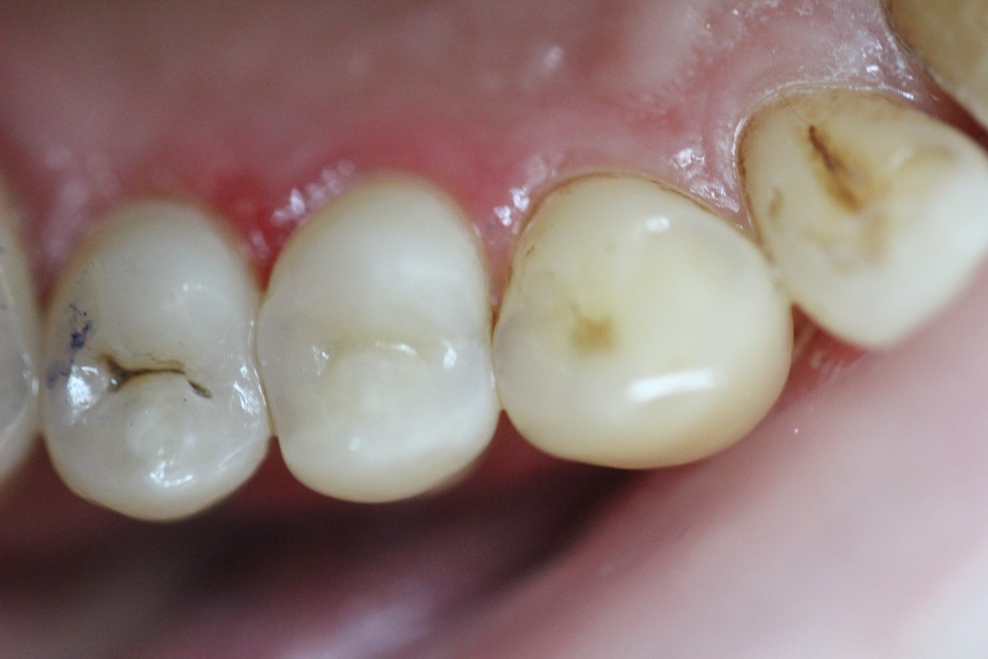 Поверхностный кариес