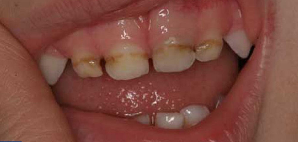 Циркуляционный кариес