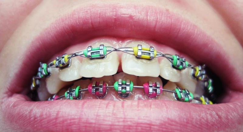 Лечение неправильного прикуса брекет-системами - фото 5