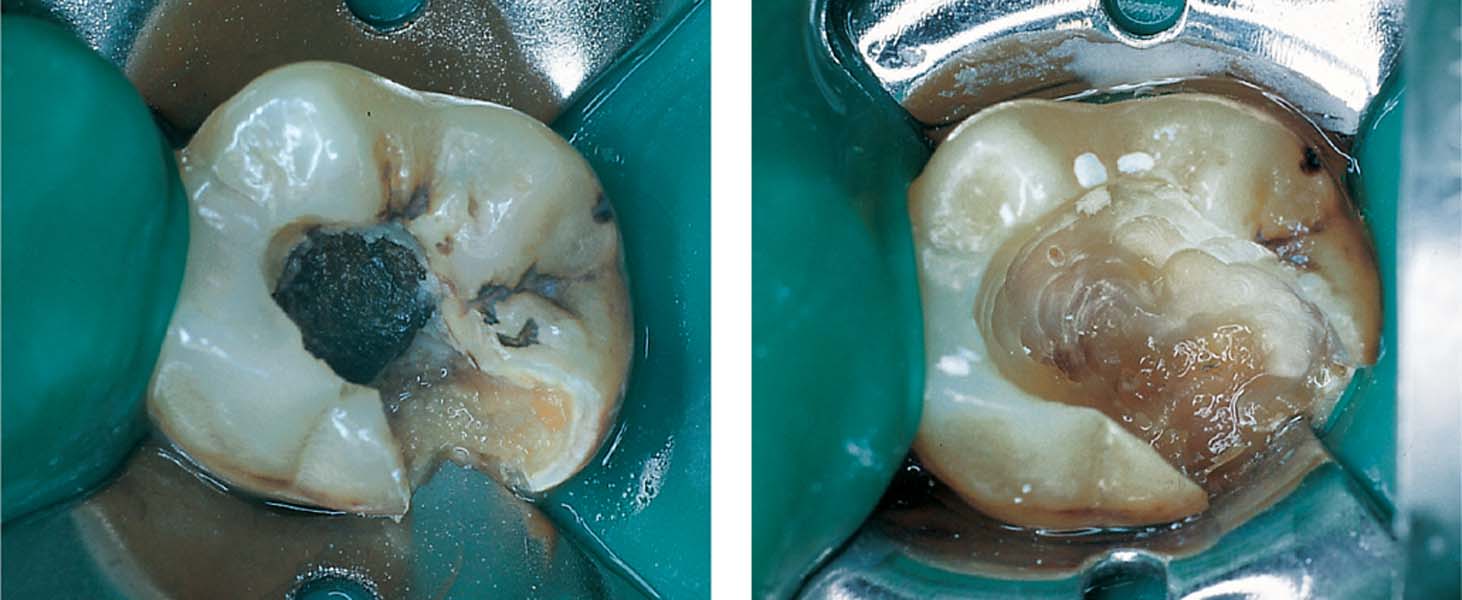 Очистка зуба от гнойного пульпита