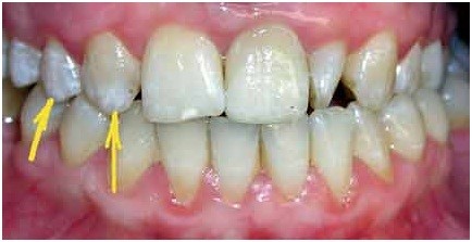 Пришеечный кариес: причины, стадии, лечение, профилактика - фото 3