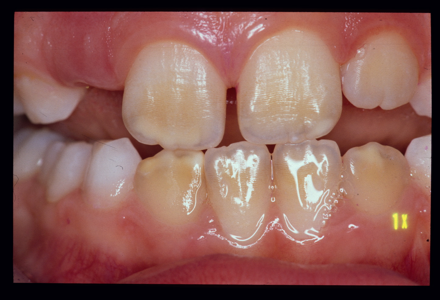 гипоплазия зубной эмали