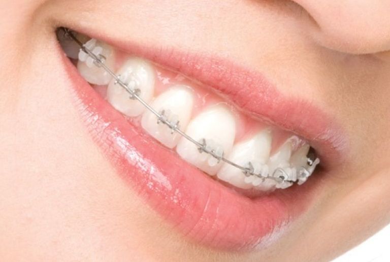 Лечение неправильного прикуса брекет-системами - фото 6