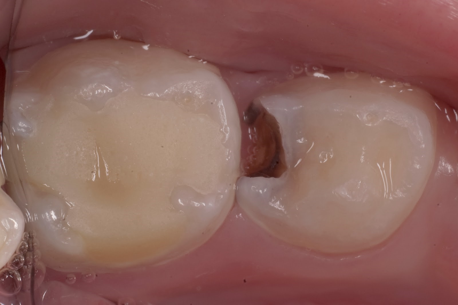 Средняя стадия кариеса