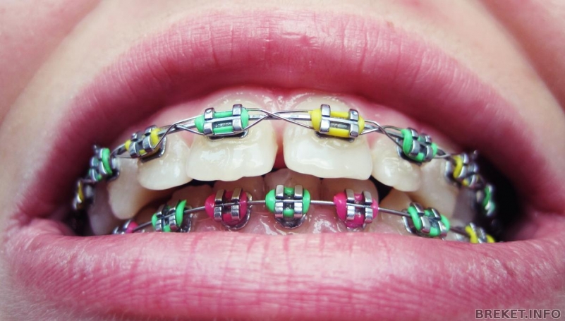 Отличительные особенности глубокого прикуса - фото 6