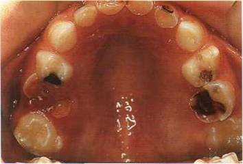 Пульпит молочных зубов: причины возникновения, симптомы и методы лечения - фото 2