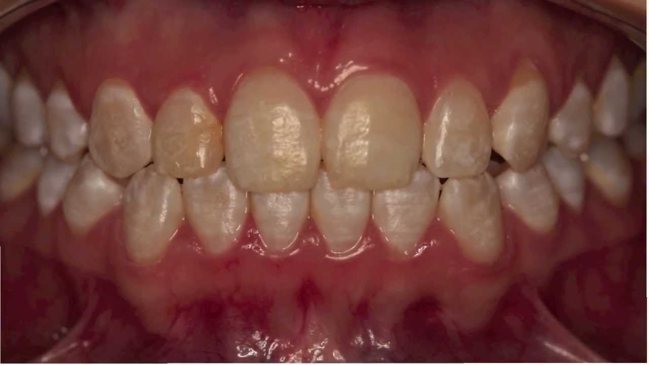 флюороз зубной эмали