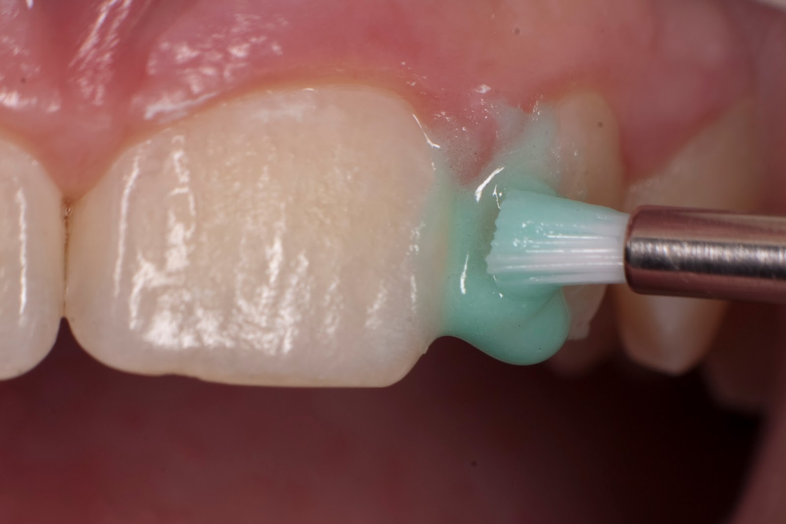 процедура аппликации