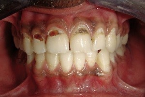 Пришеечный кариес: причины, стадии, лечение, профилактика - фото 5