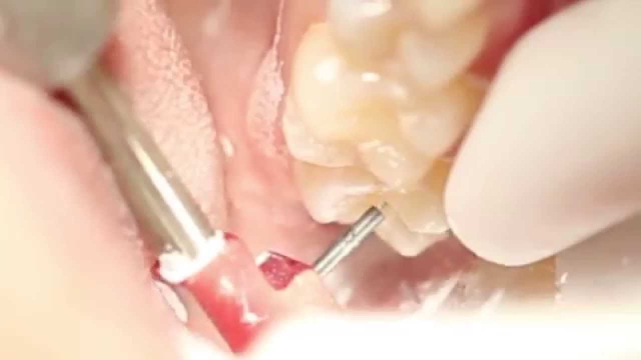 Лечение кариеса воздушно-абразивным способом