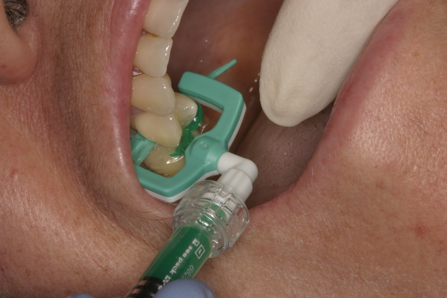 Инфильтрация зубов