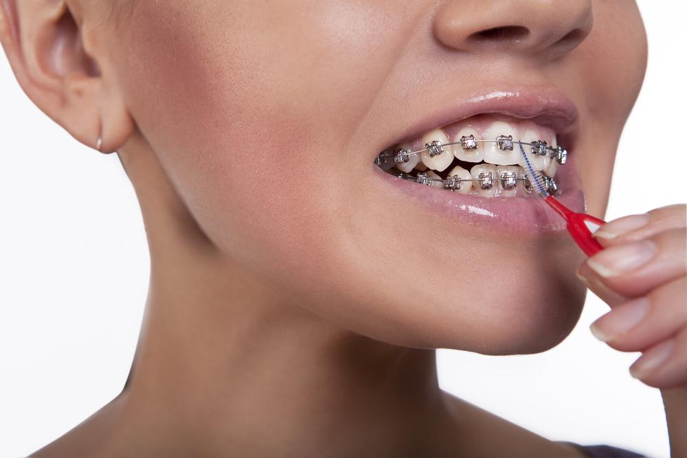 Лечение неправильного прикуса брекет-системами - фото 9