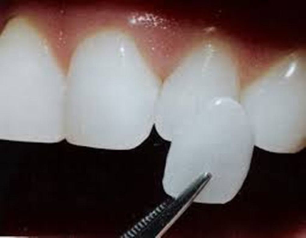 установка виниров