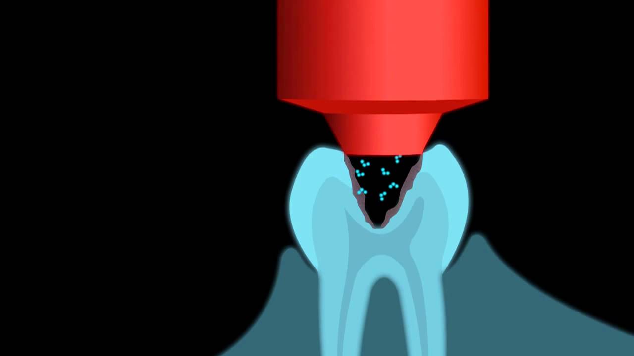 Схема действия озонотерапии