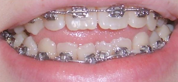 Открытый прикус: причины, симптомы, лечение, профилактика - фото 5