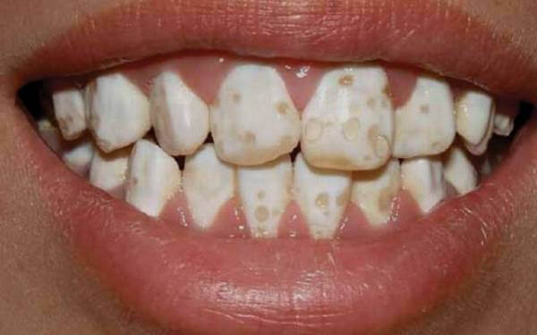 Генетическое нарушение твердых тканей зуба