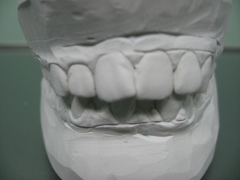 Дистальный прикус: как обнаружить и что делать - фото 5