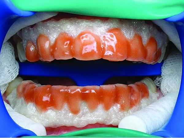 Химическое отбеливание зубов