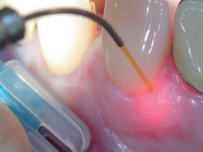 Лазерное отбеливание зубов