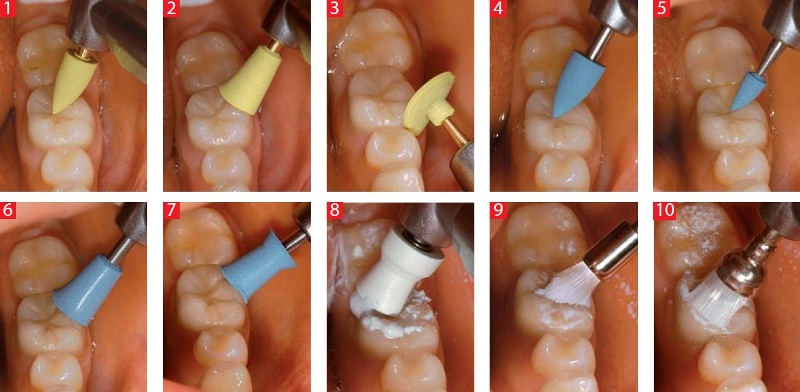 Механическое очищение эмали зубов